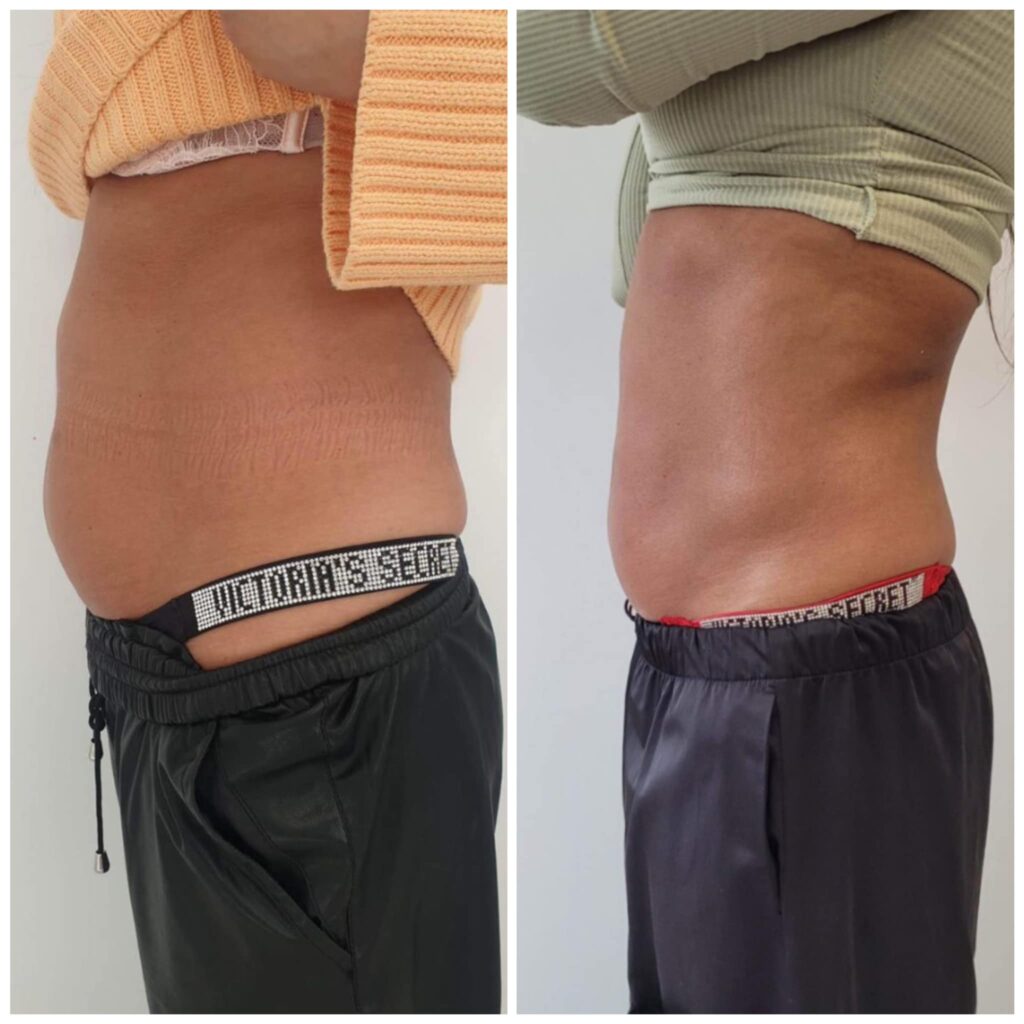 Efekt zabiegu EXIMIA — przykład 3